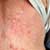 Life-Threatening Skin Rashes